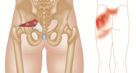 Puntos gatillo piriformes y referencia del dolor