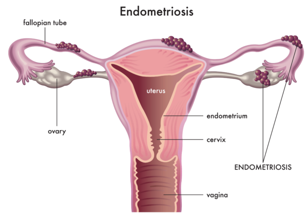 Diagrama de útero con endometriosis.  Fisioterapia del suelo pélvico para el tratamiento de la endometriosis Propel Fisioterapia.